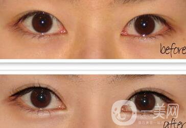 全切雙眼皮術(shù)后怎么護(hù)理？需要注意什么