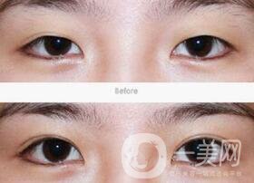 全切雙眼皮術(shù)后怎么護(hù)理？需要注意什么