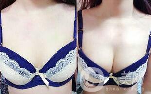 隆胸手術(shù)后多久恢復(fù)？術(shù)后注意事項有哪些