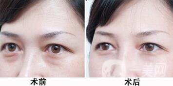 激光去眼袋的副作用 需要如何處理