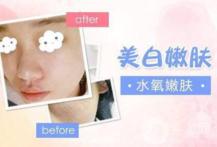 重慶,光子嫩膚,多少錢