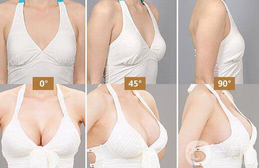 隆胸取出醫(yī)院介紹？隆胸取出后應(yīng)該要注意什么