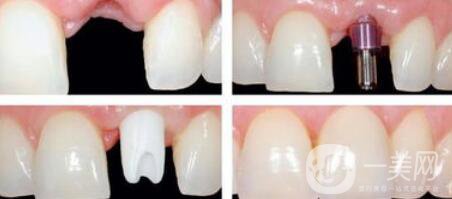 種植牙是怎么操作的？種植牙的過程