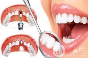 深圳種植牙手術價格大概是多少？