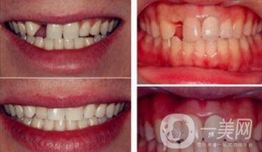 深圳種植牙手術價格大概是多少？