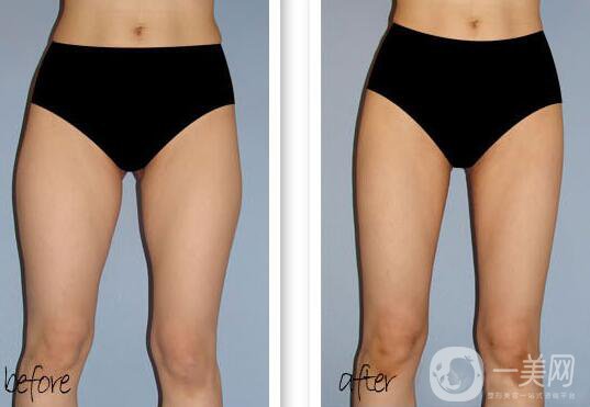 大腿吸脂多久恢復？大腿吸脂后遺癥有哪些