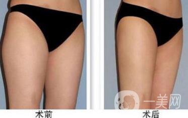 大腿吸脂多久恢復？大腿吸脂后遺癥有哪些