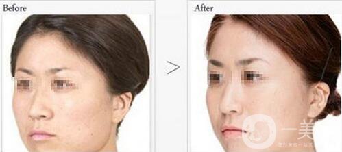 廣州做一次黑臉娃娃多少錢 價格表一覽