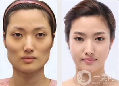 磨顴骨手術(shù)之后容易有后遺癥么？主要有哪些情況？