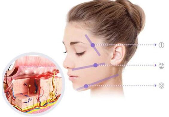 北京,非手術(shù)面部提升,大概需要多少錢