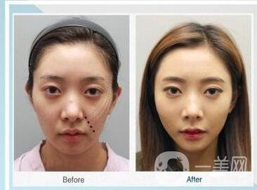 北京,非手術(shù)面部提升,大概需要多少錢