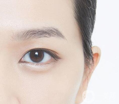 開(kāi)眼角,適宜人群