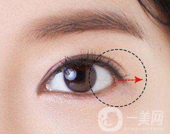 開眼角需要注意些什么？