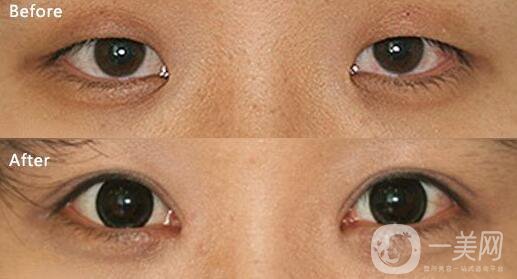 開眼角,醫(yī)院