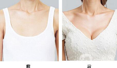 假體隆胸多久開始按摩？具體如何操作