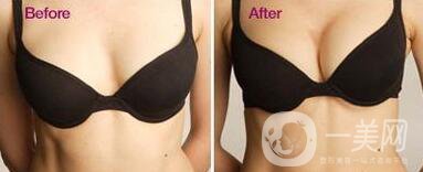 假體隆胸多久開始按摩？具體如何操作