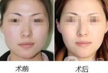 去頰脂墊瘦臉術(shù)前注意事項(xiàng)有哪些