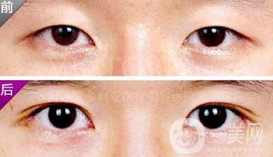 埋線雙眼皮之后禁忌有哪些？具體注意事項(xiàng)介紹