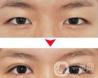 埋線雙眼皮之后禁忌有哪些？具體注意事項(xiàng)介紹