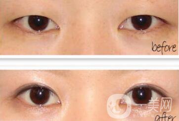 埋線雙眼皮之后禁忌有哪些？具體注意事項(xiàng)介紹