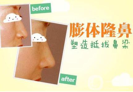 膨體隆鼻,*果怎么樣,圖