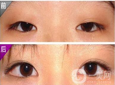 韓國,開眼角,多少錢