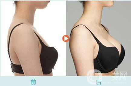 自體脂肪隆胸后多久可以恢復(fù)上班？