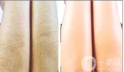 深圳,激光脫毛,價格