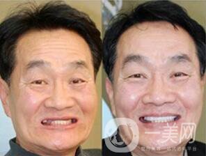 登騰在醫(yī)院轉(zhuǎn)做種植牙需要多少錢 價格影響因素有哪些