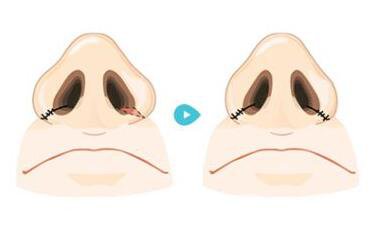 鼻翼縮小術是*的嗎？