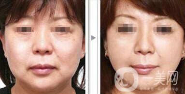 塑美極*果怎么樣？塑美極的副作用