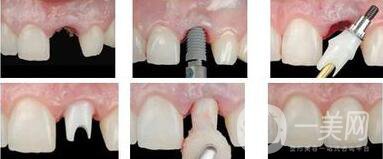 廣州做種植牙價多少錢？費用高嗎