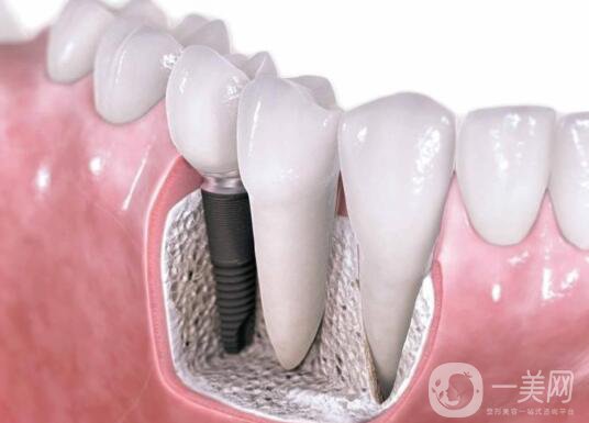 廣州做種植牙價多少錢？費用高嗎