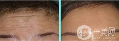 *注射去皺多久見*