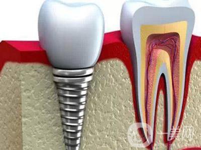 北京種植牙多少錢(qián) 種植牙過(guò)程和原理