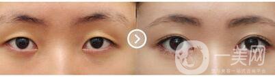 割雙眼皮對(duì)眼睛有什么壞處