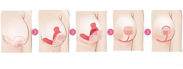 北京乳房下垂矯正手術多少錢