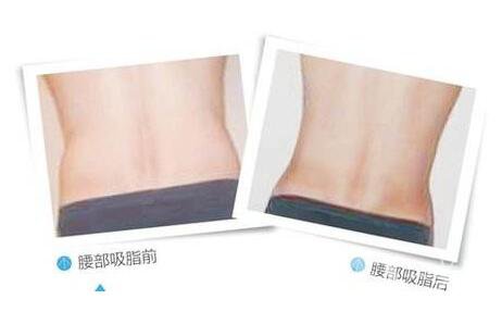 腰腹吸脂,*果呢,多久見(jiàn)*