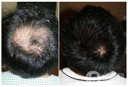 上海fut植發(fā)價格多少錢