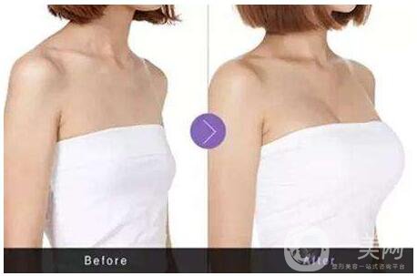 北京麥格假體隆胸價格多少錢