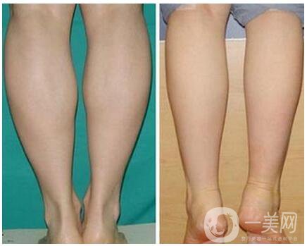 成都注射*瘦腿多少錢 會(huì)不會(huì)反彈