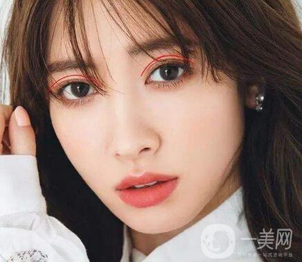 焊接雙眼皮是什么？多久能好？