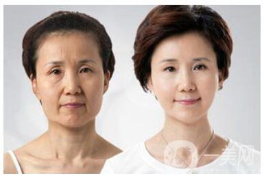 武漢注射*去皺要多少錢