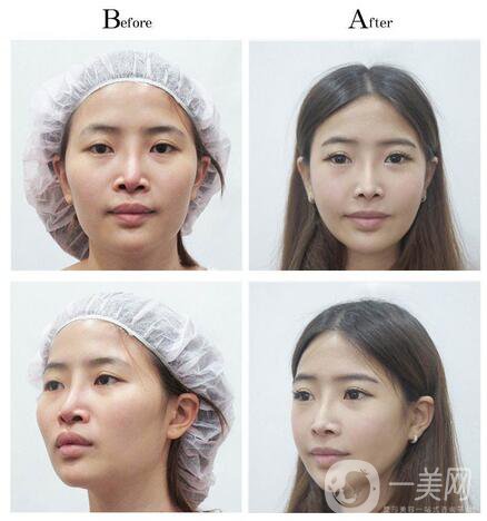 上海整形醫(yī)院做磨骨手術(shù)多少錢