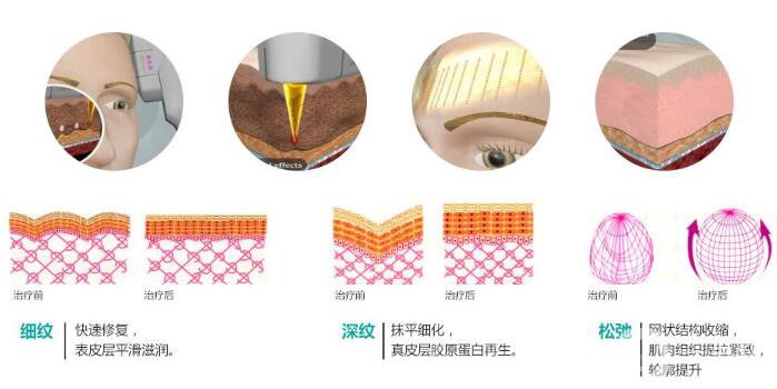 彩光嫩膚有用嗎 術(shù)后護理簡析