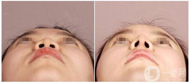 *術(shù)后能吃牛肉嗎 *手術(shù)后要注意什么