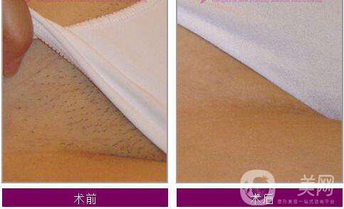 廈門女性比基尼部位脫毛價格一般是多少