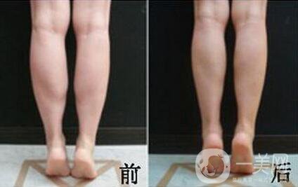 *注射瘦小腿*果怎么樣？