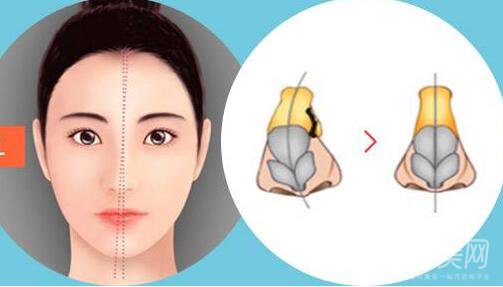 歪鼻矯正手術(shù)多少錢？