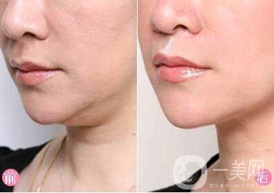 去掉雙下巴多少錢？
